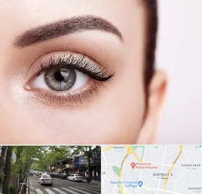 فوق تخصص عنبیه در ظفر 