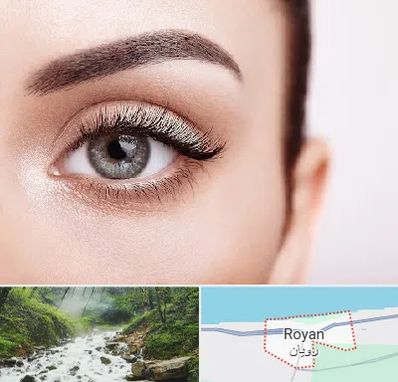 فوق تخصص عنبیه در رویان