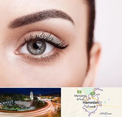 فوق تخصص عنبیه در همدان