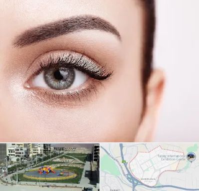 فوق تخصص عنبیه در مرزداران تبریز