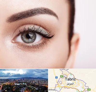 فوق تخصص عنبیه در تبریز