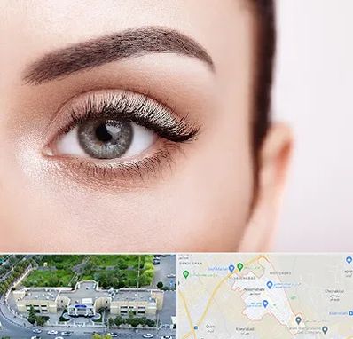 فوق تخصص عنبیه در نسیم شهر