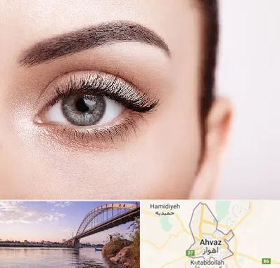 فوق تخصص عنبیه در اهواز