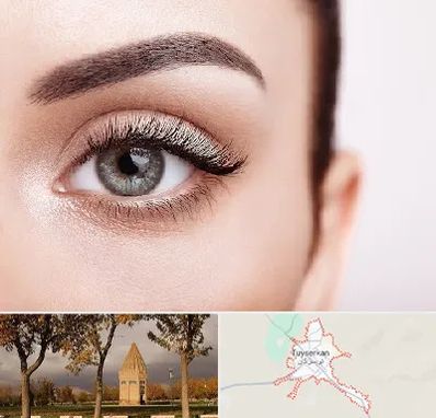 فوق تخصص عنبیه در تویسرکان