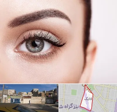 فوق تخصص عنبیه در اتابک