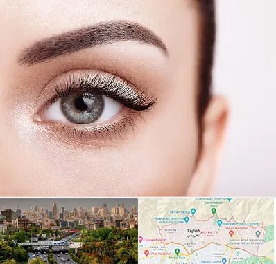 فوق تخصص عنبیه در منطقه 1 تهران 