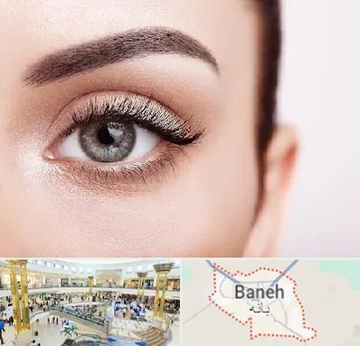 فوق تخصص عنبیه در بانه