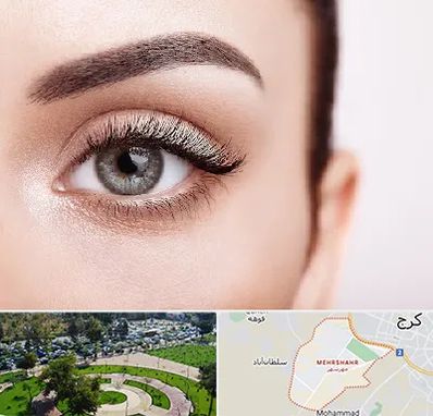 فوق تخصص عنبیه در مهرشهر کرج 