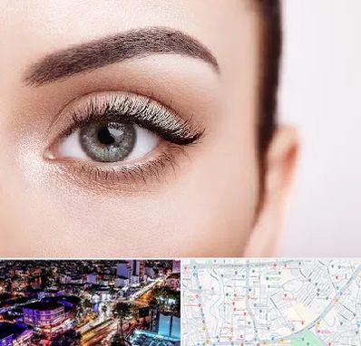 فوق تخصص عنبیه در منظریه رشت