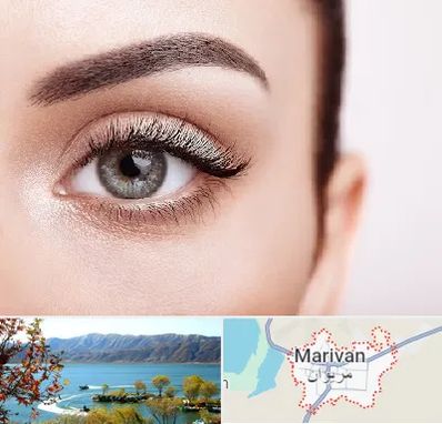 فوق تخصص عنبیه در مریوان