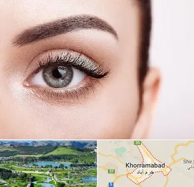 فوق تخصص عنبیه در خرم آباد