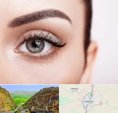 فوق تخصص عنبیه در کامیاران