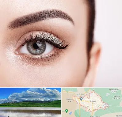 فوق تخصص عنبیه در مرند