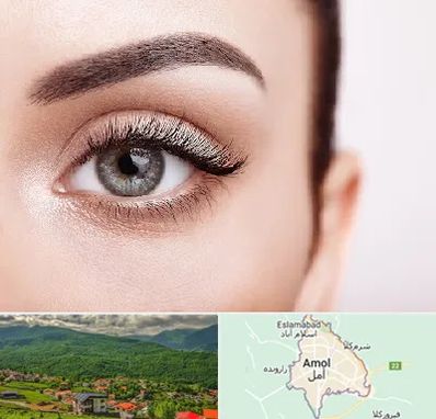 فوق تخصص عنبیه در آمل