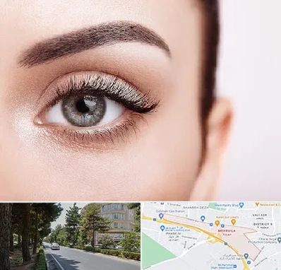 فوق تخصص عنبیه در مهرویلا کرج