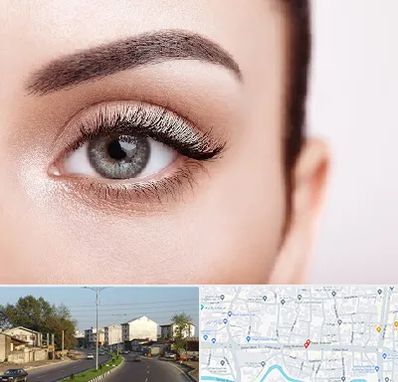 فوق تخصص عنبیه در ضیابری رشت