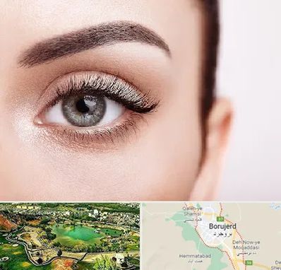 فوق تخصص عنبیه در بروجرد