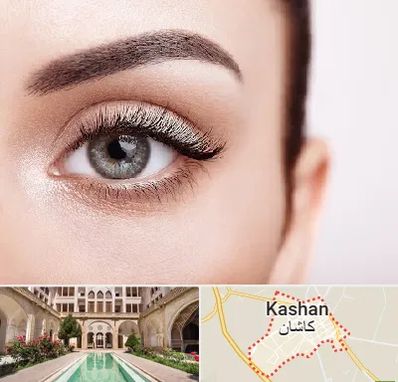 فوق تخصص عنبیه در کاشان