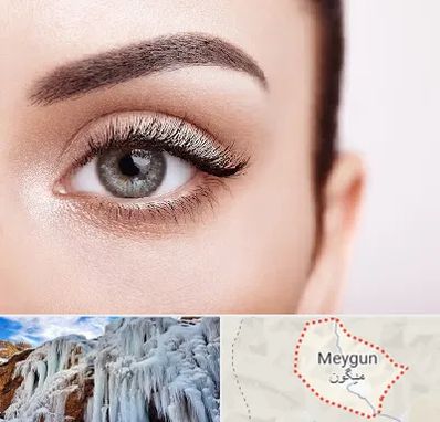 فوق تخصص عنبیه در میگون