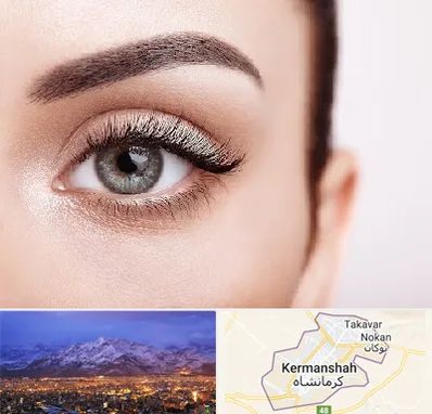 فوق تخصص عنبیه در کرمانشاه