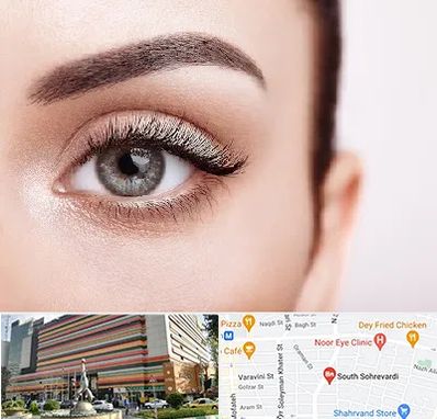 فوق تخصص عنبیه در سهروردی 