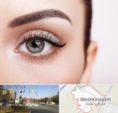 فوق تخصص عنبیه در مشکین دشت