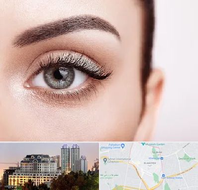 فوق تخصص عنبیه در فرشته 