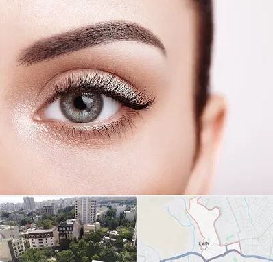 فوق تخصص عنبیه در اوین