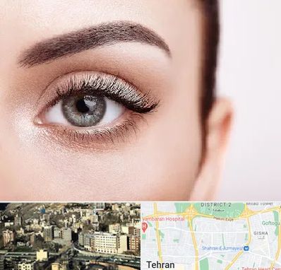 فوق تخصص عنبیه در مرزداران 