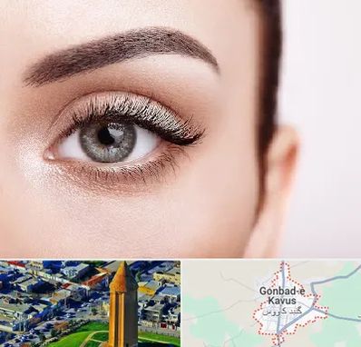 فوق تخصص عنبیه در گنبد کاووس