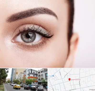 فوق تخصص عنبیه در هفده شهریور تبریز