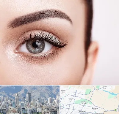 فوق تخصص عنبیه در شمال شرق تهران