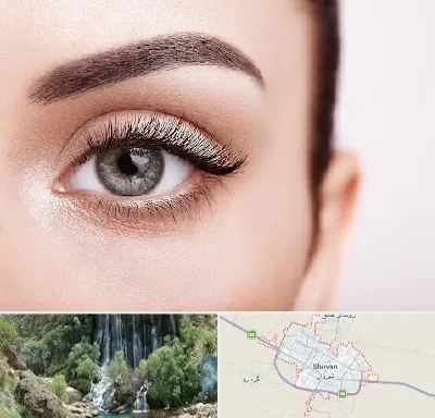فوق تخصص عنبیه در شیروان