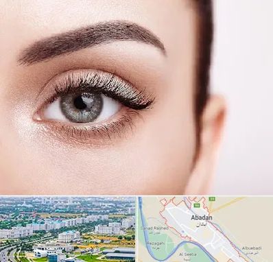 فوق تخصص عنبیه در آبادان