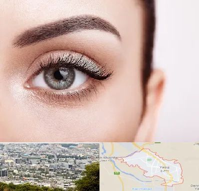 فوق تخصص عنبیه در یاسوج