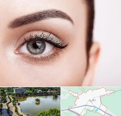 فوق تخصص عنبیه در لنگرود