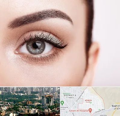 فوق تخصص عنبیه در عظیمیه کرج 