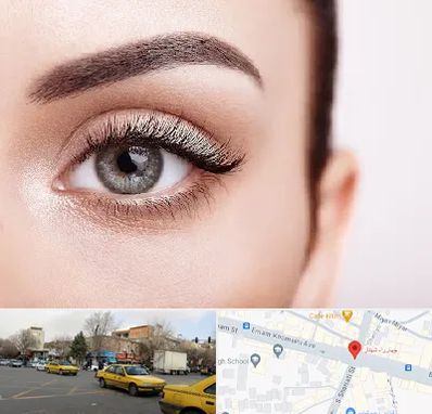 فوق تخصص عنبیه در شهناز تبریز