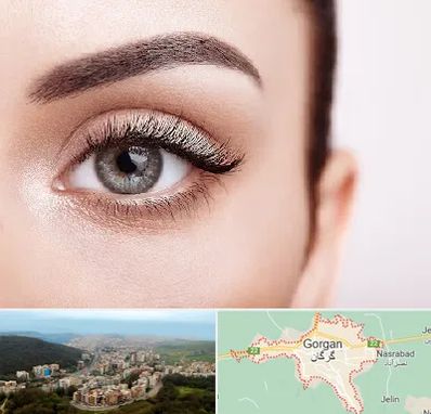 فوق تخصص عنبیه در گرگان