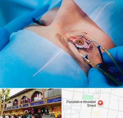 عمل prk چشم در 15 خرداد