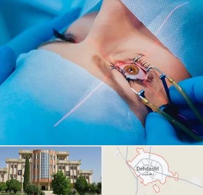 عمل prk چشم در دهدشت