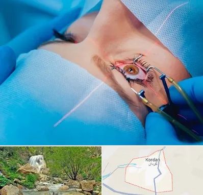 عمل prk چشم در کردان