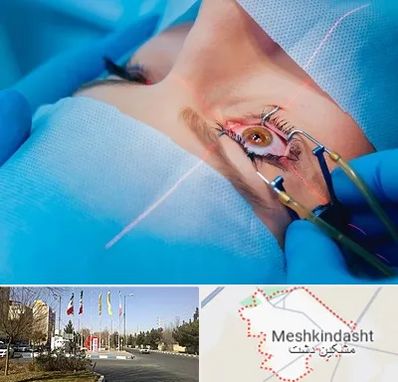 عمل prk چشم در مشکین دشت