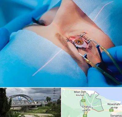 عمل prk چشم در چالوس