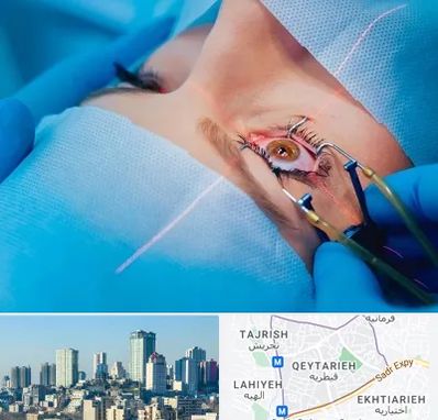 عمل prk چشم در قیطریه 