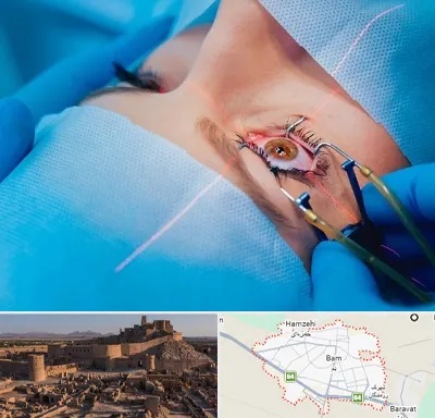 عمل prk چشم در بم