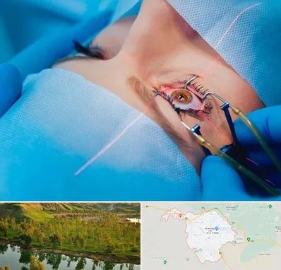 عمل prk چشم در بهبهان