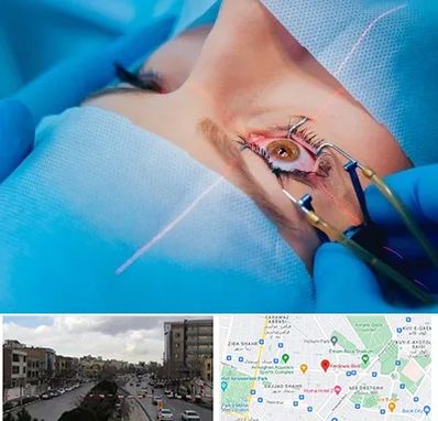 عمل prk چشم در بلوار فردوسی مشهد 