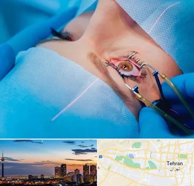 عمل prk چشم در غرب تهران 