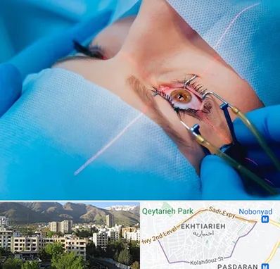 عمل prk چشم در اختیاریه 